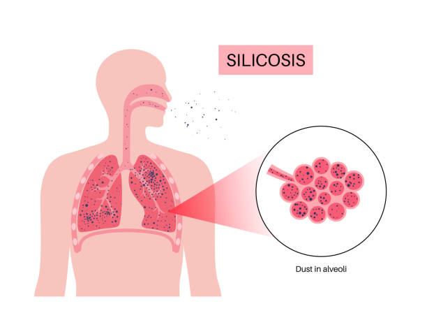 Silicosis epidemic plagues Zimbabwe’s artisanal miners